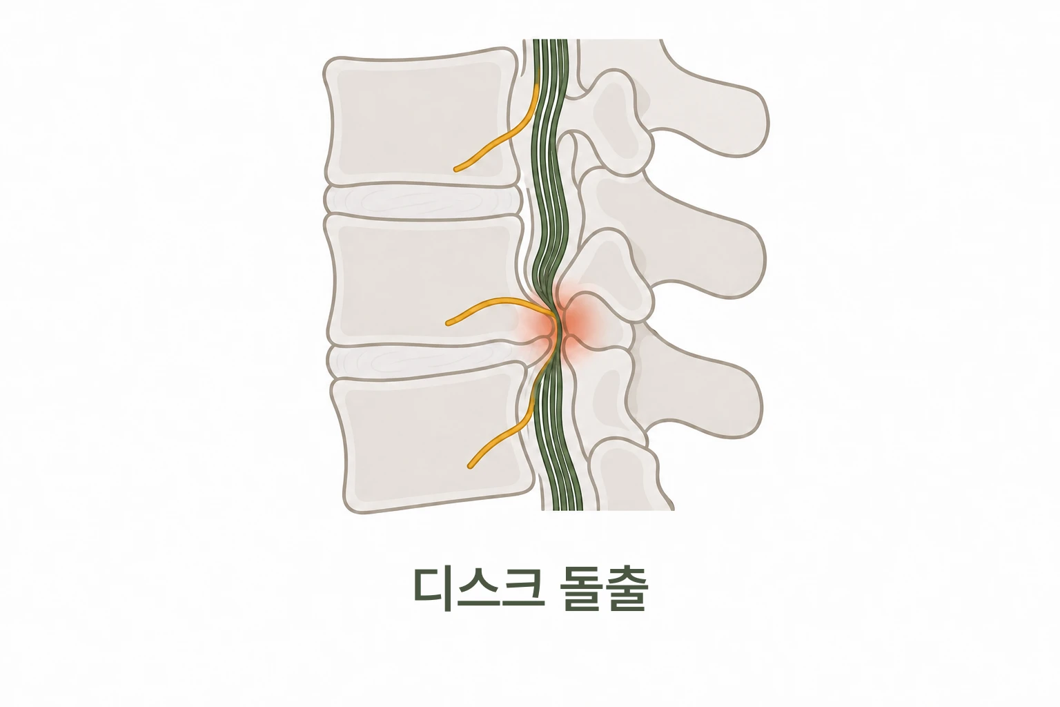 척추 사이 디스크가 돌출되어 신경을 누르는 모습을 그린 그림