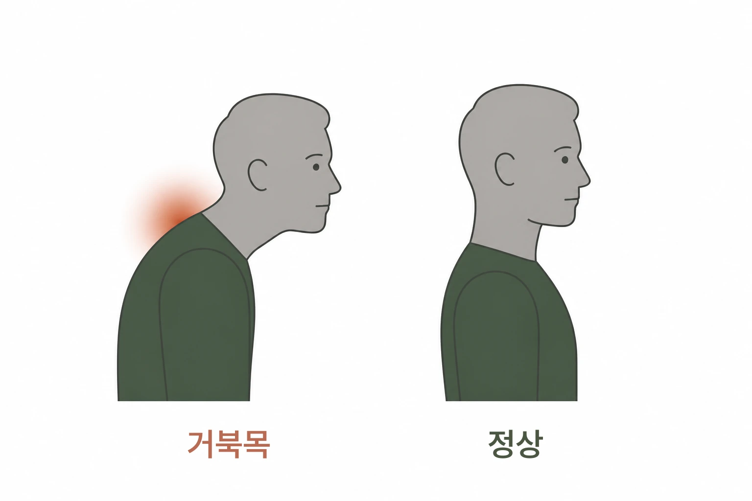 거북목 자세와 정상 목 자세를 나란히 비교한 그림