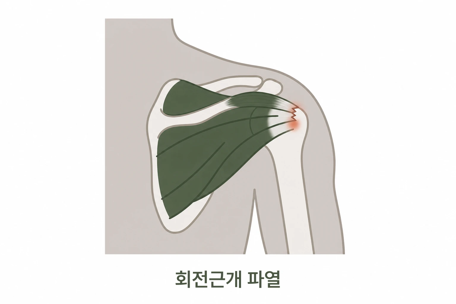 어깨 회전근개가 파열된 위치를 표시한 그림