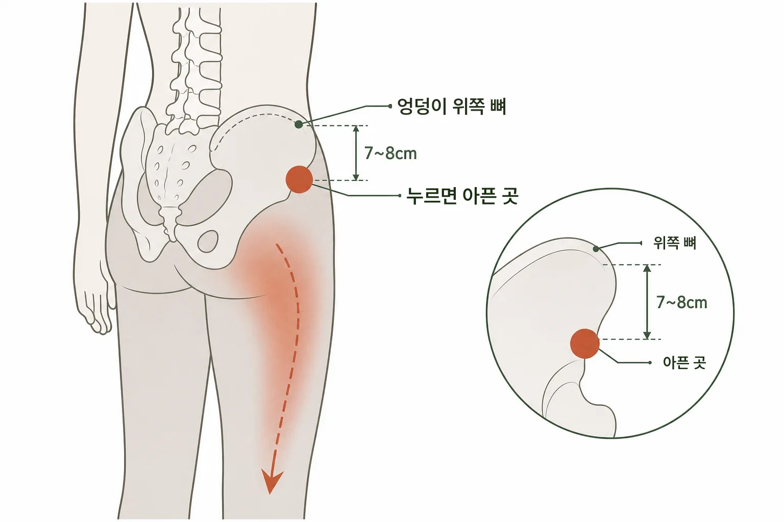 엉덩이 통증이 다리로 내려가는데, 디스크일까요? 설명 이미지