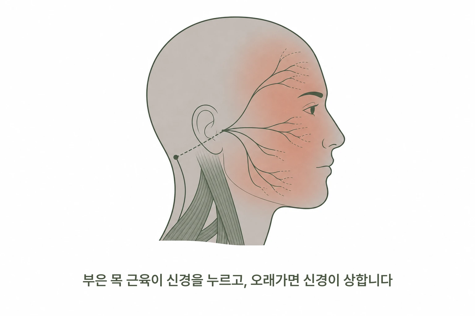 얼굴에 퍼진 화끈거림과 귀 앞에서 갈라지는 가는 신경섬유, 목에서 올라온 신호가 두개골 아래에서 만나는 자리를 보여주는 일러스트