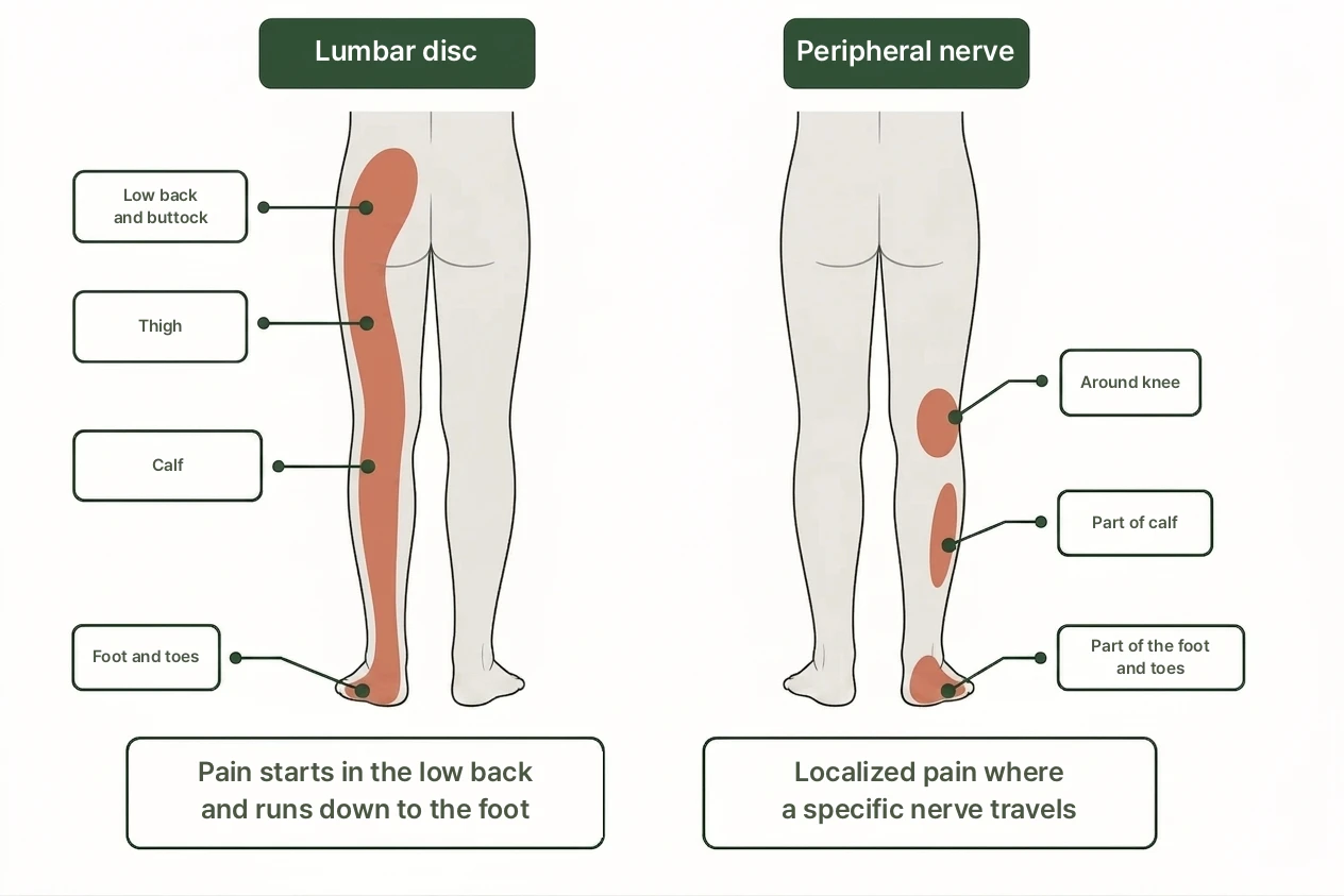 What Is Peripheral Nerve Entrapment? illustration