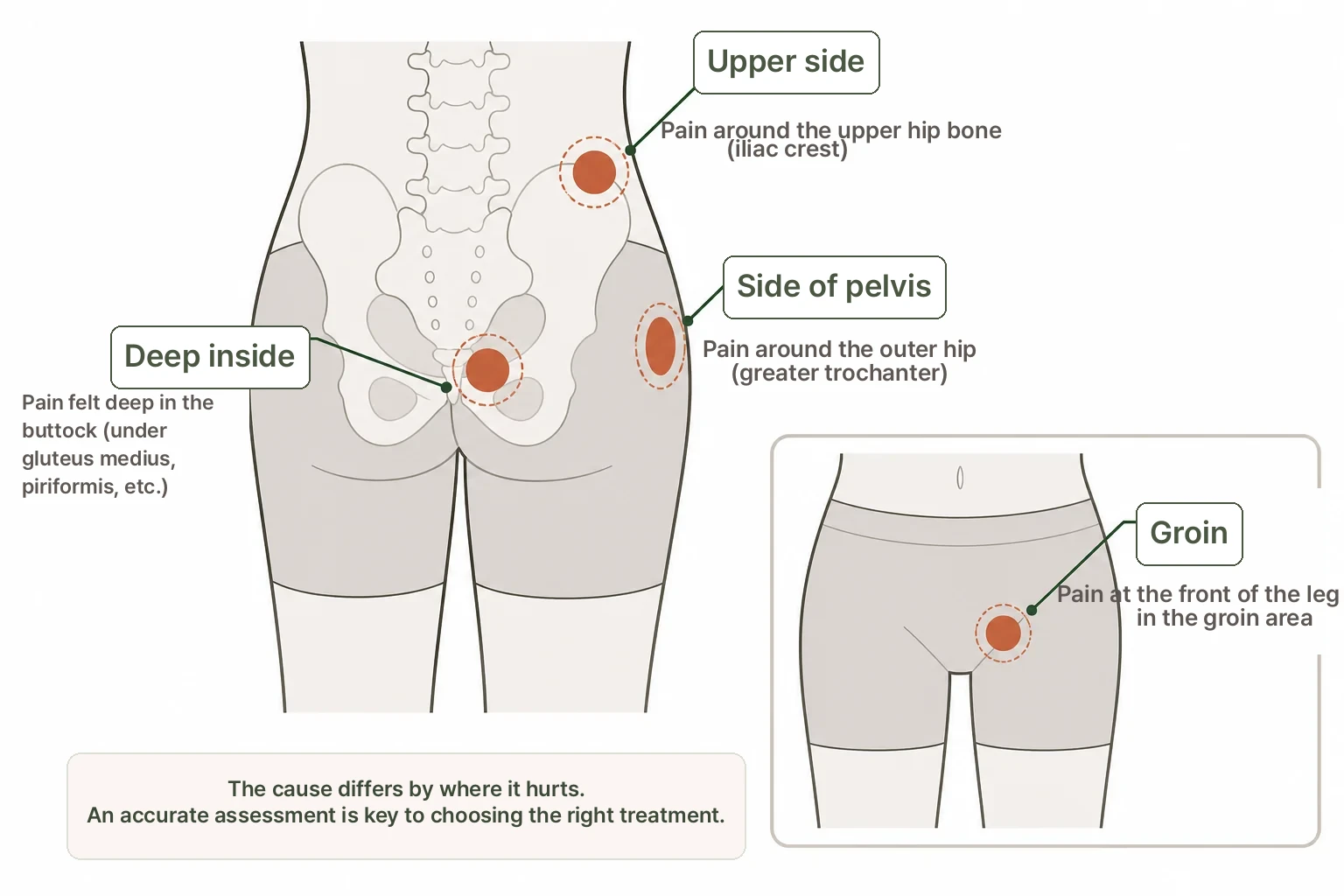 Hip Pain Causes by Location illustration