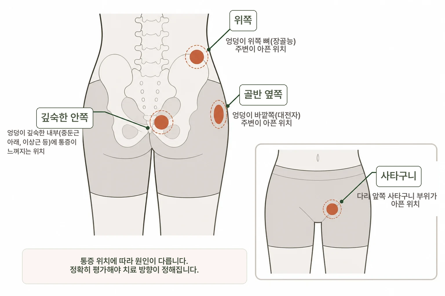 엉덩이가 아파요 설명 이미지