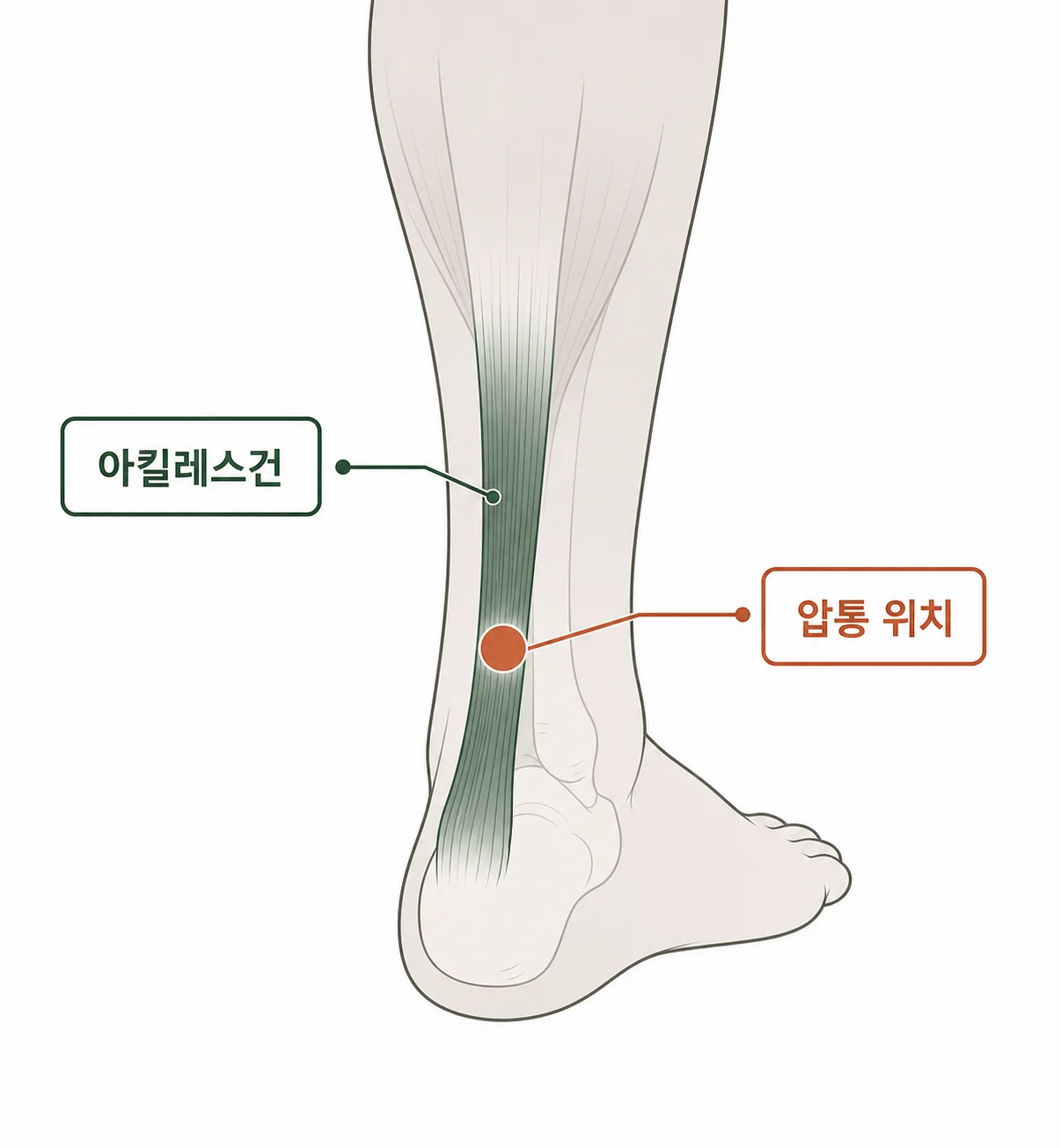 하이록스 후 아킬레스가 왜 뻣뻣해질까요? 설명 이미지