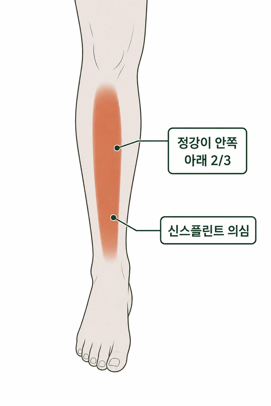 하이록스 후 정강이가 아파요, 신스플린트일까요? 설명 이미지