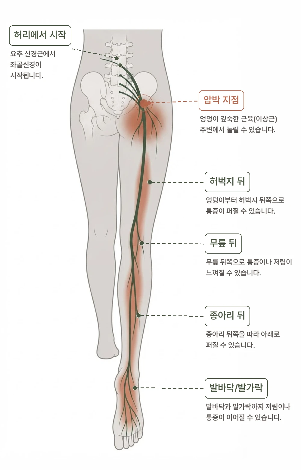 좌골신경통은 어떻게 치료하나요? 설명 이미지