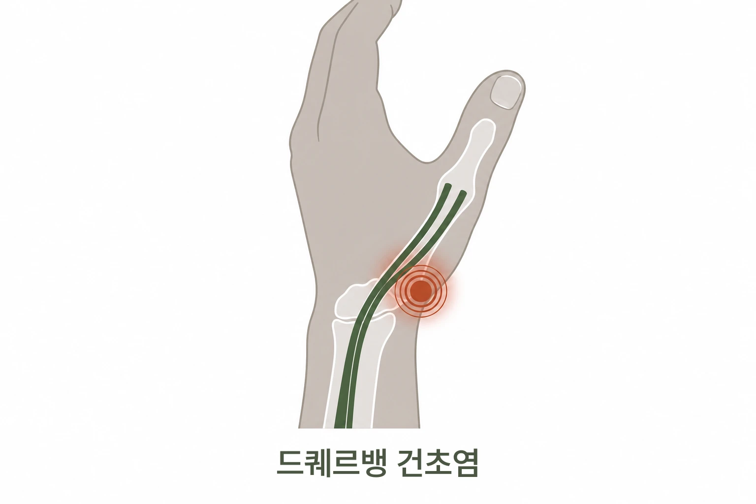 드퀘르벵 건초염 엄지 손목 통증 일러스트