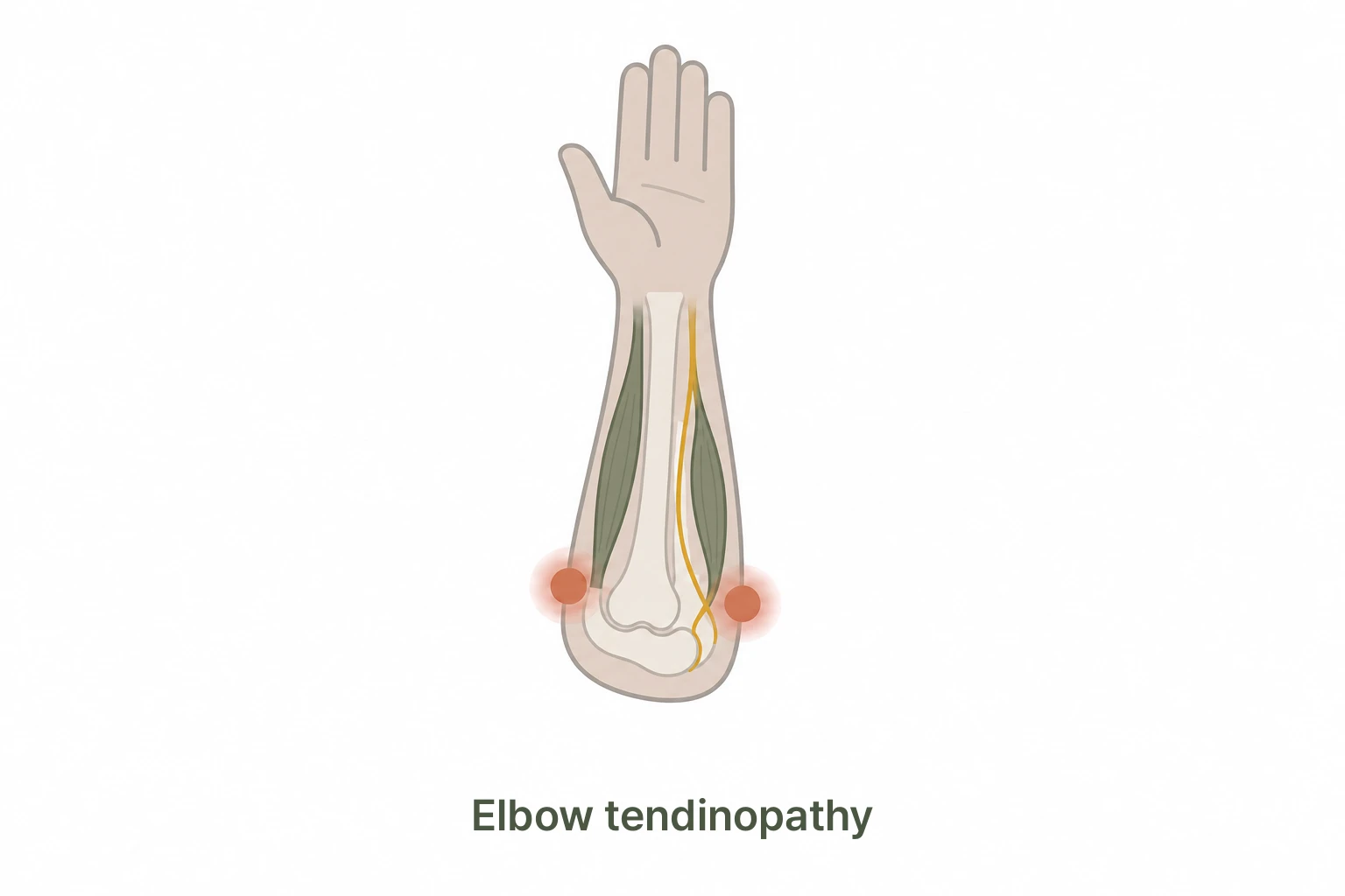 Tennis Elbow vs Golfer's Elbow comparison - inner side is Golfer's Elbow