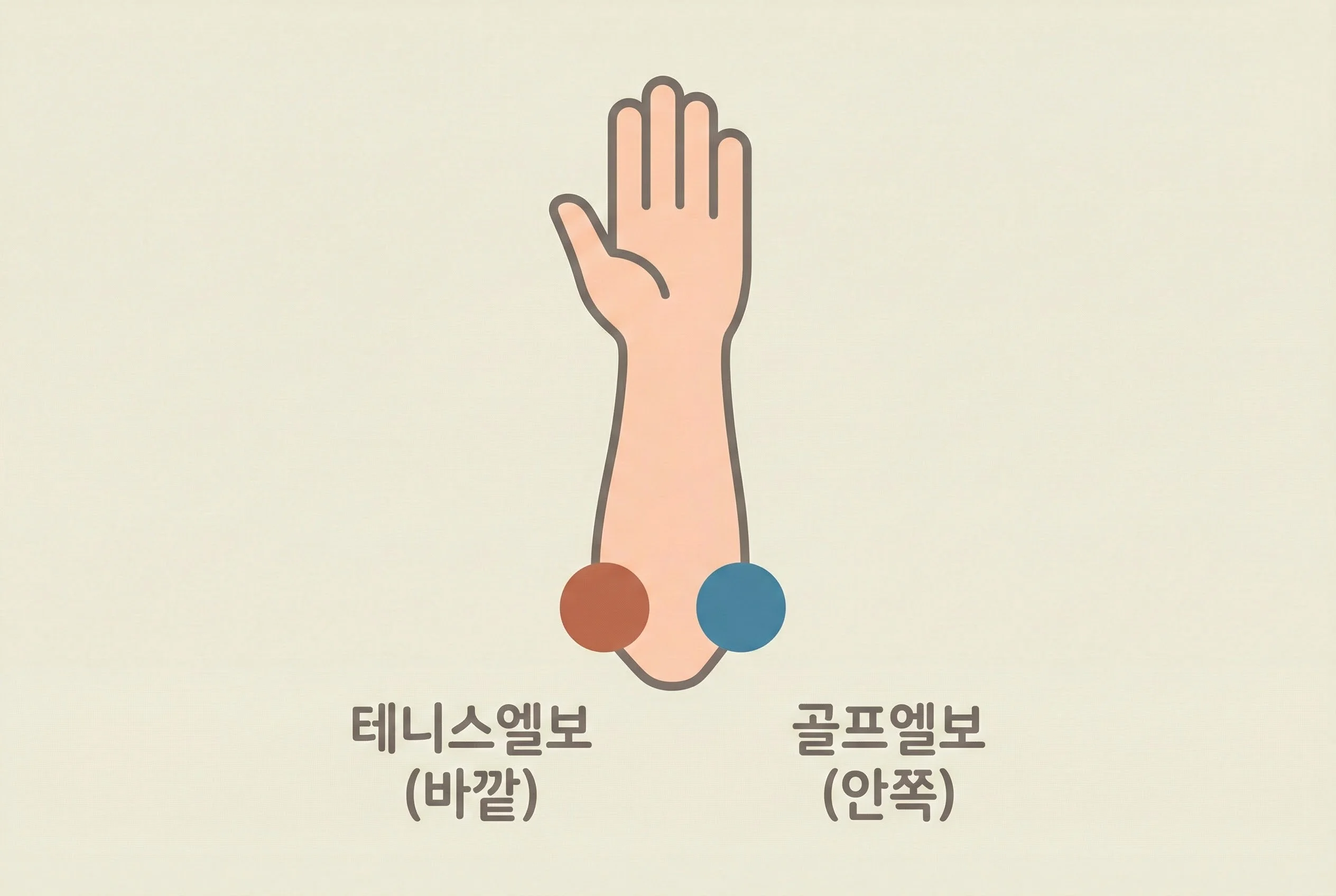 테니스엘보 vs 골프엘보 비교 일러스트 - 바깥쪽이 테니스엘보