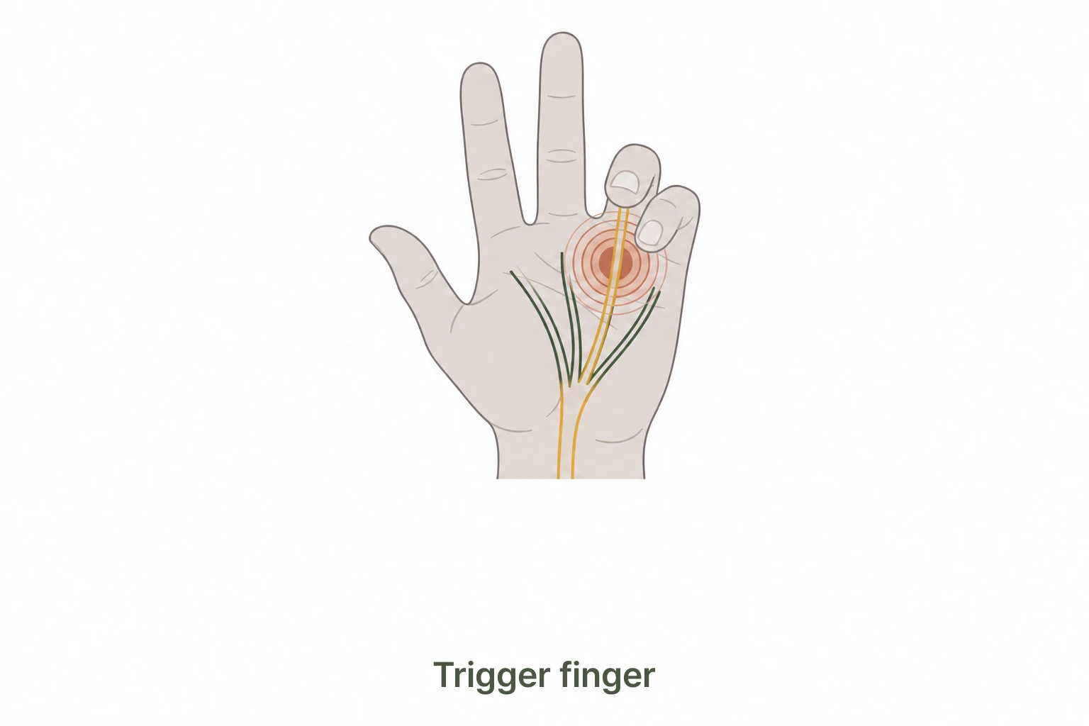 Trigger finger tendon pulley catching illustration