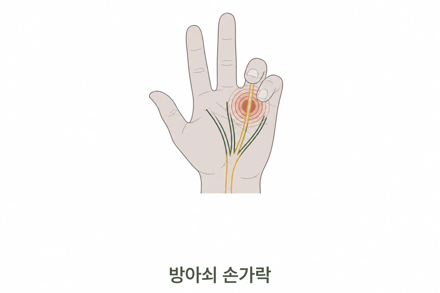 방아쇠 손가락 힘줄 도르래 통증 일러스트