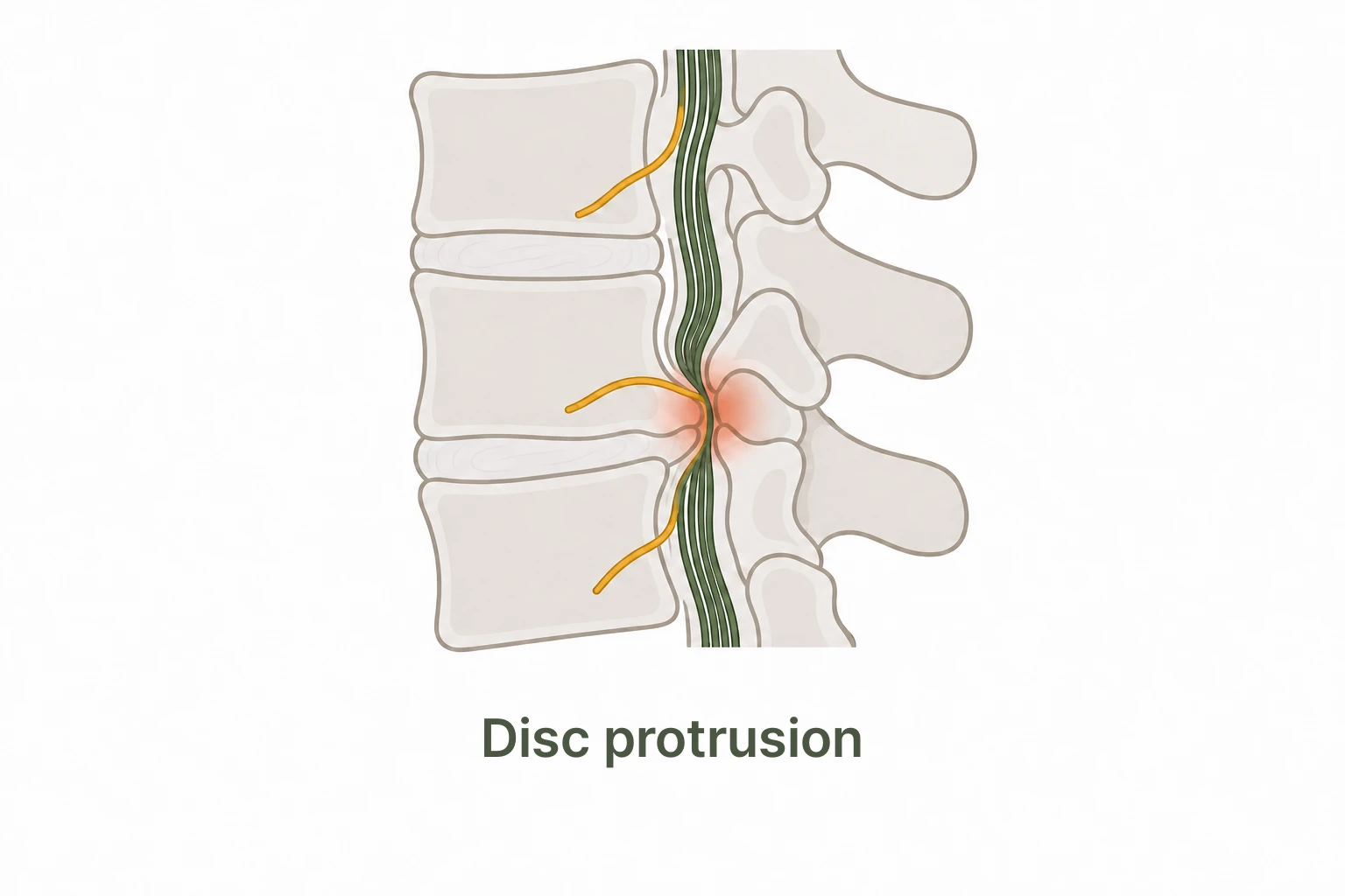 A spinal disc protruding and pressing on the nerve