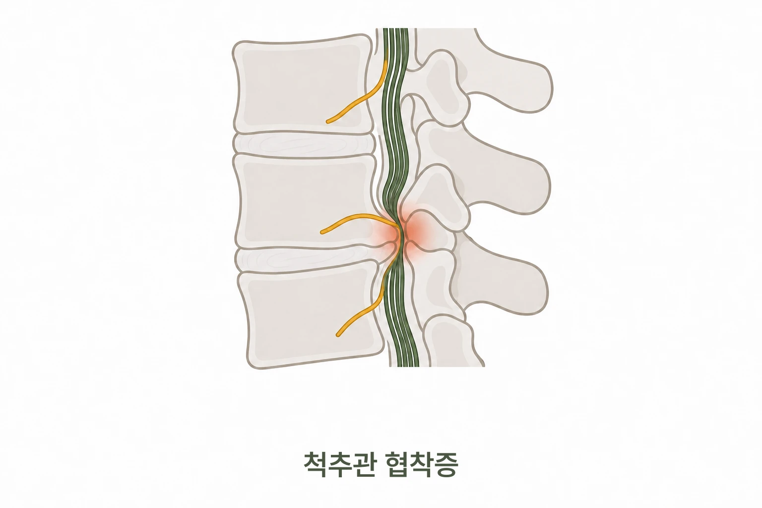 척추관 협착증 신경 압박 일러스트