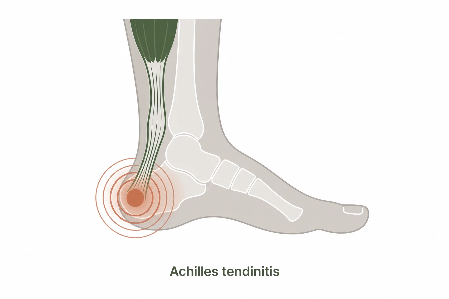 Illustration of Achilles tendinitis pain location
