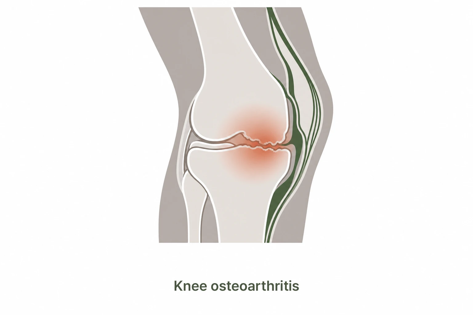 Worn cartilage in a knee with osteoarthritis