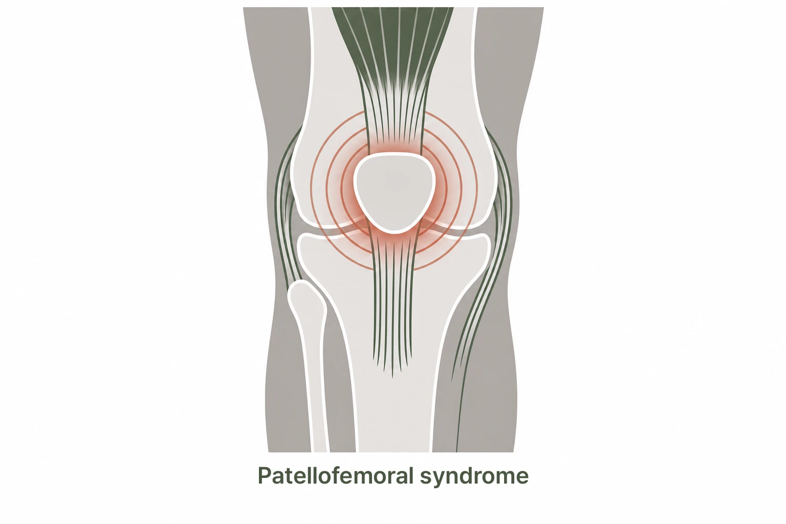 Patellofemoral syndrome kneecap alignment illustration