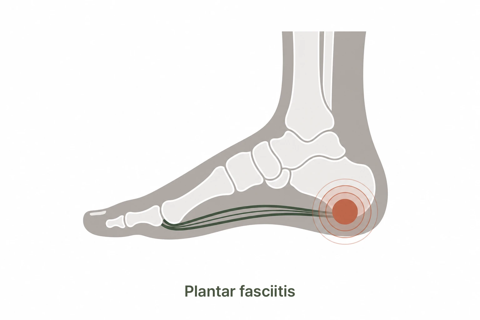 Plantar fasciitis heel pain illustration