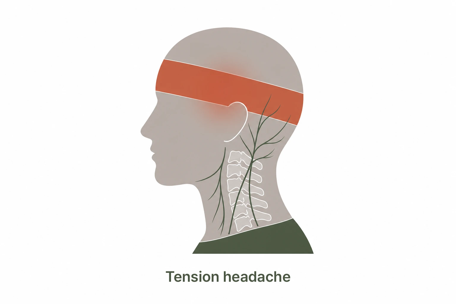 Tension headache area illustration