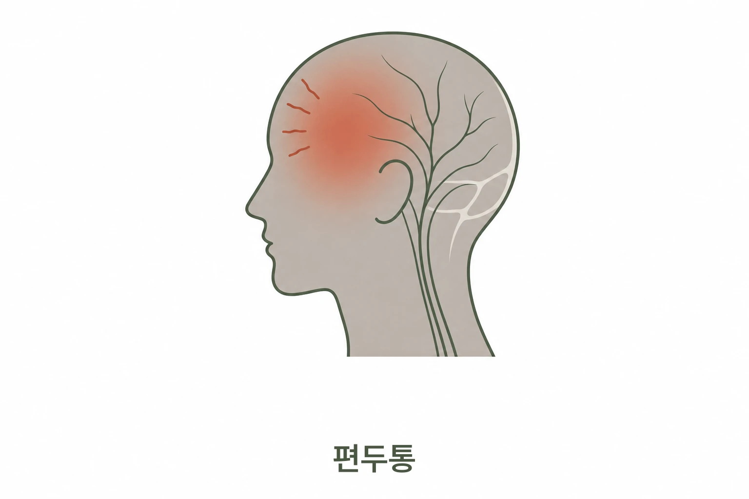 편두통 증상 일러스트
