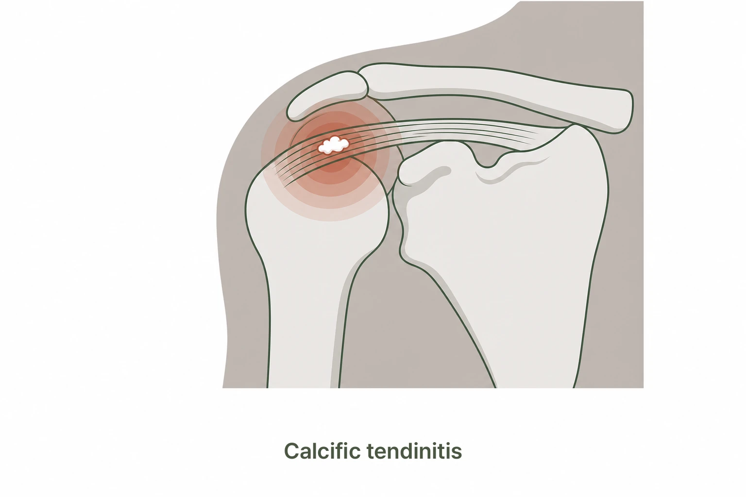 Calcific tendinitis calcium deposit in shoulder tendon illustration