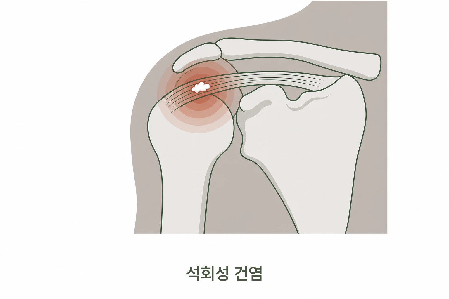 석회성 건염 어깨 힘줄 칼슘 침착 일러스트