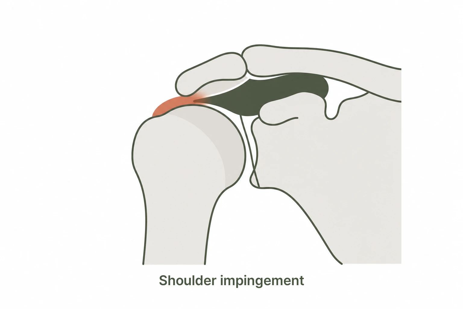 Impingement syndrome subacromial space illustration