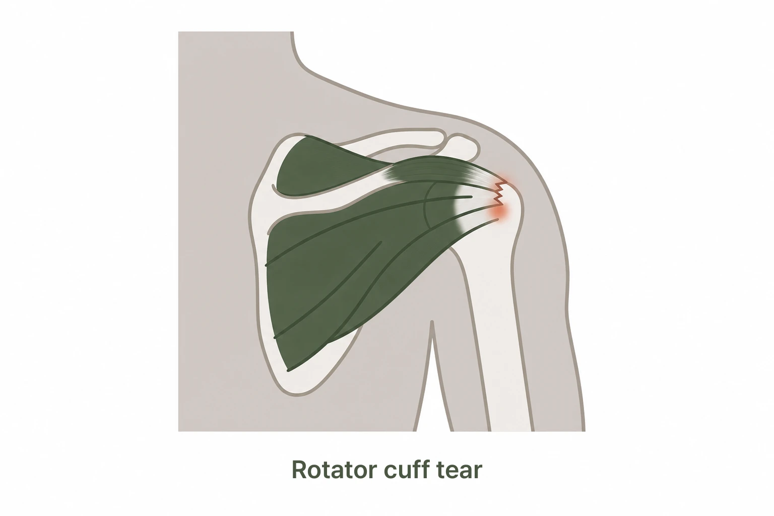 The location of a rotator cuff tear in the shoulder
