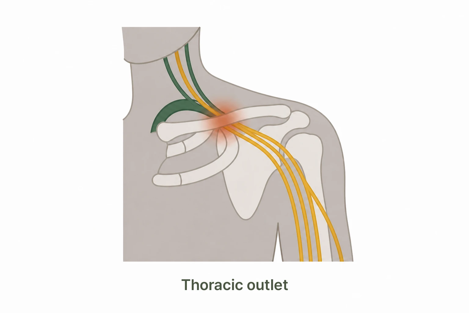 Thoracic outlet syndrome neurovascular compression illustration