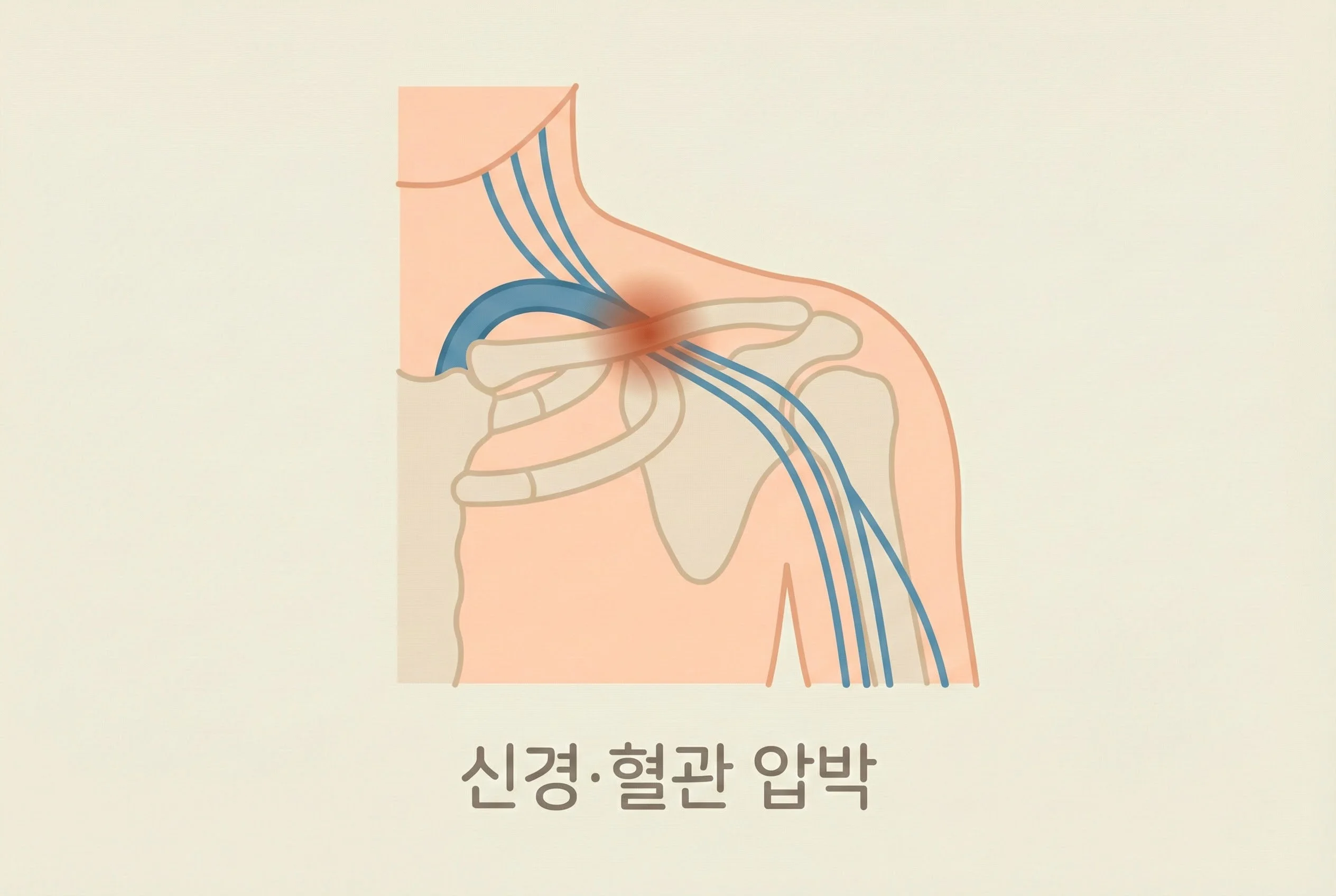 흉곽출구증후군 신경혈관 압박 일러스트
